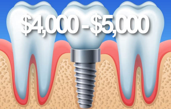 Price dental implants Brisbane.