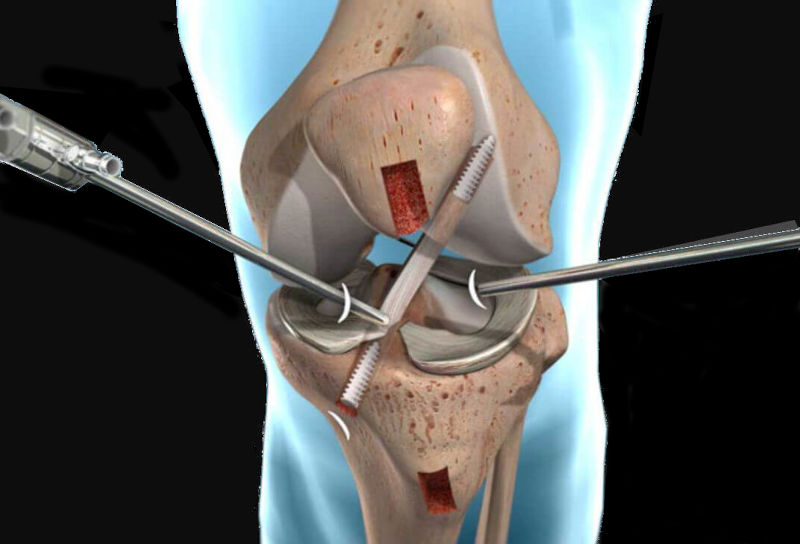 ACL knee surgery or knee replacement surgery Perth.